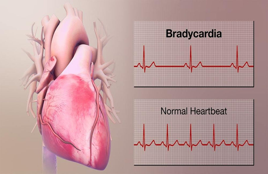 Low Heart Rate - When Should I Worry about Bradycardia