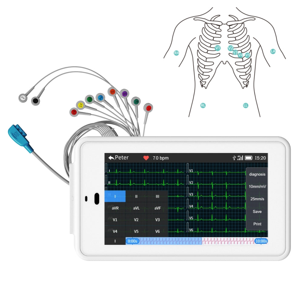 ポケットに収まるモバイル 6/12 誘導 EKG/ECG マシン、自動解釈機能付き、ワイヤレスで ECG レポートを電子メールで共有 – Wellue